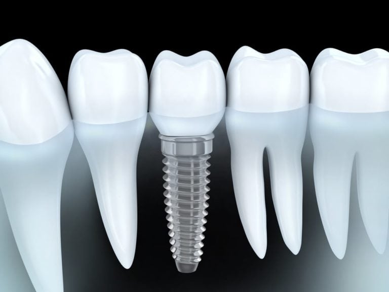 Image of Dental Implants Can Restore Your Smile