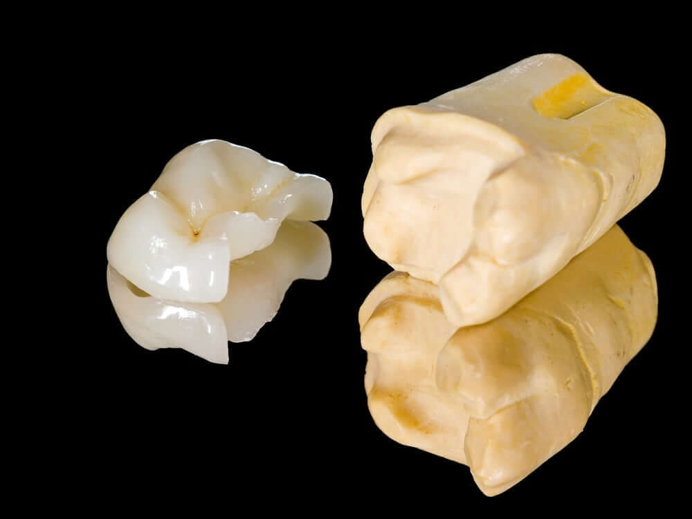 Image of Inlay and onlay damaged teeth that need more than a filling