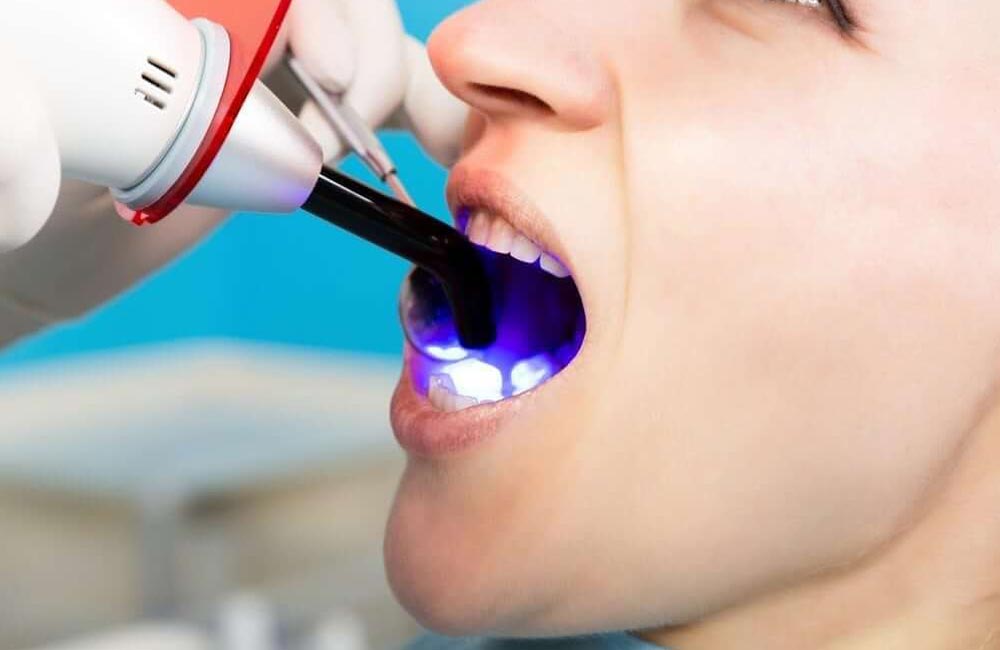 Dental Bonding Image