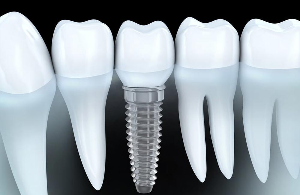 Dental Implants Image