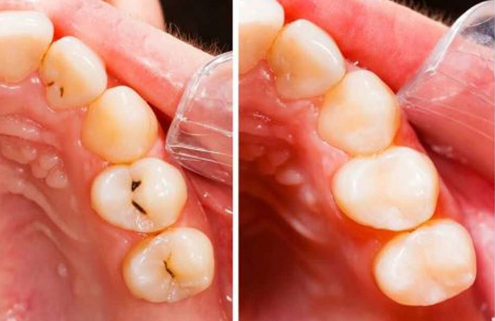 Composite Tooth-Colored Fillings