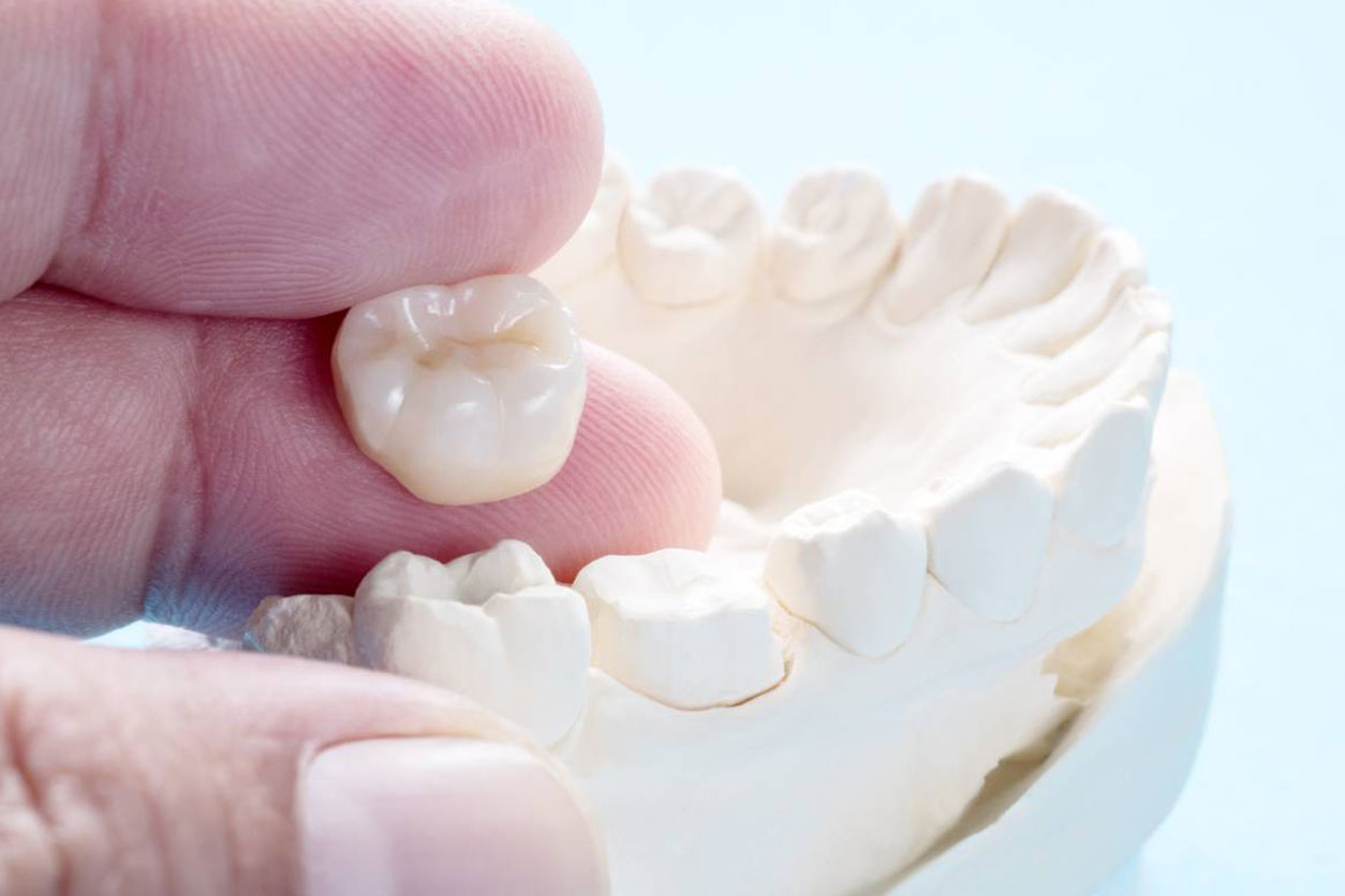 Do dental crowns need replacing