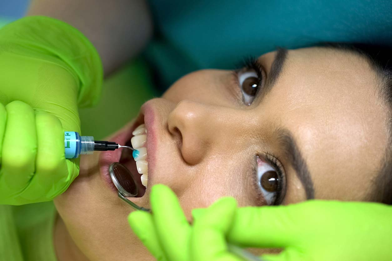 Dental bonding is a great way to fix a chipped tooth.