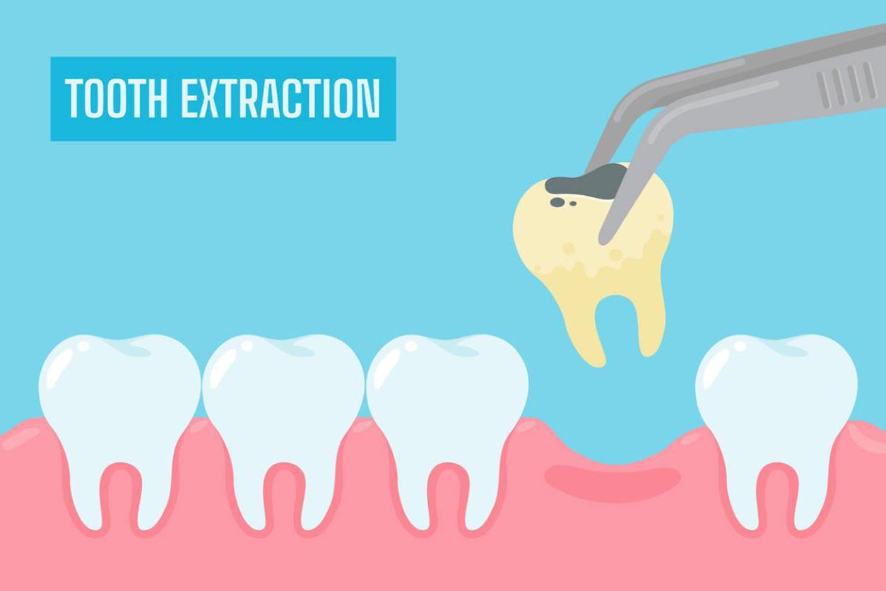 Illustration of yellow tooth being pulled.