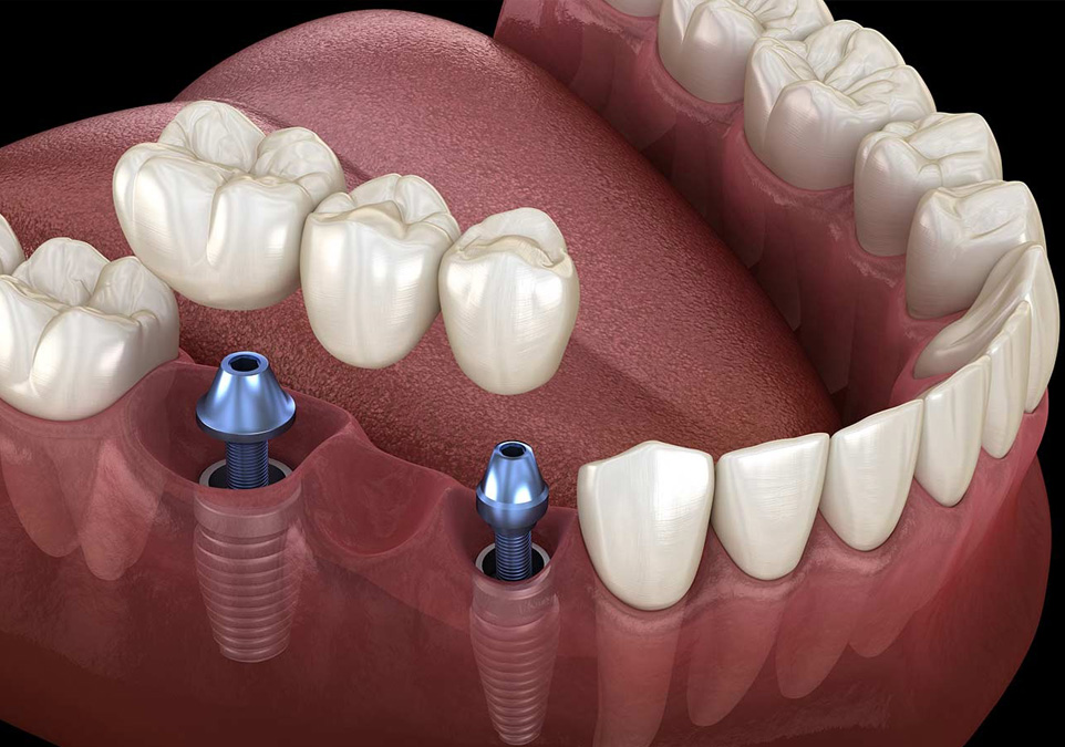 2d image of dental bridges inside mouth