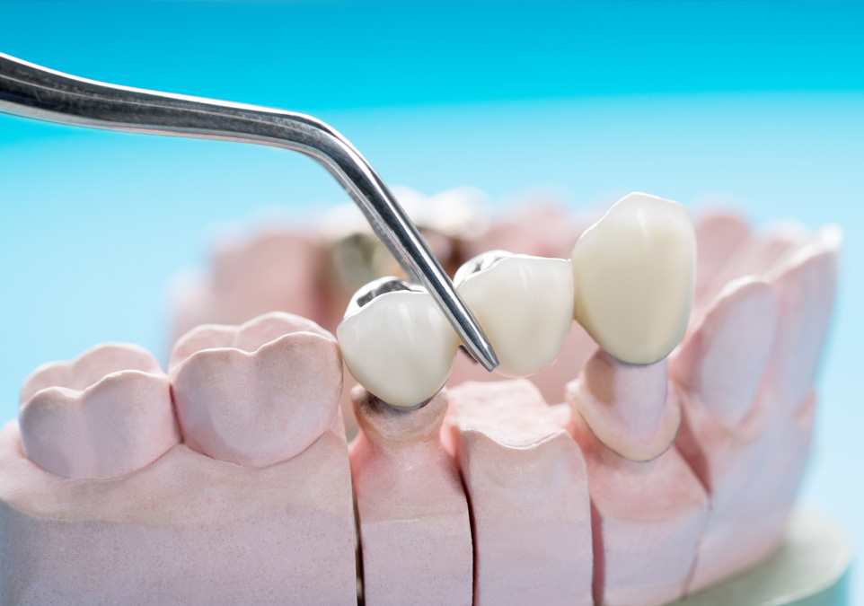 Stock image of fixing dental crowns on moulds