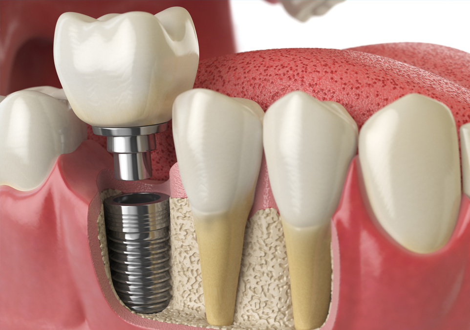 2d image of dental implants