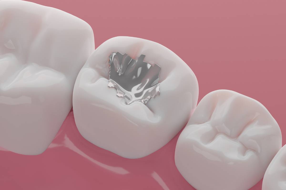 Featured image for Do Dental Fillings Hurt?