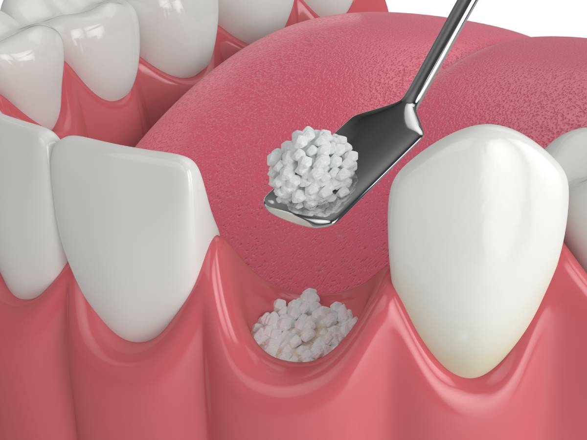 Featured image for Do You Need a Bone Graft After Tooth Extraction?