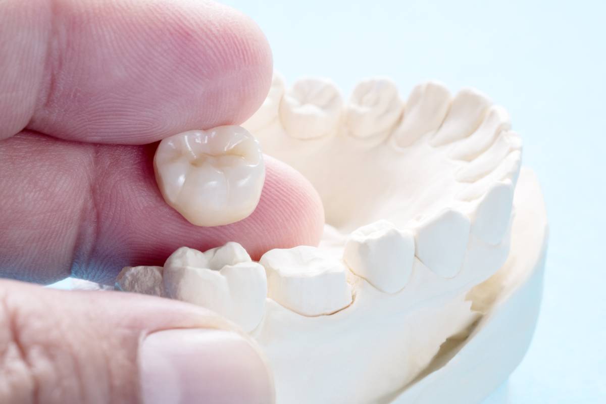 Do Dental Crowns Need Replacing?