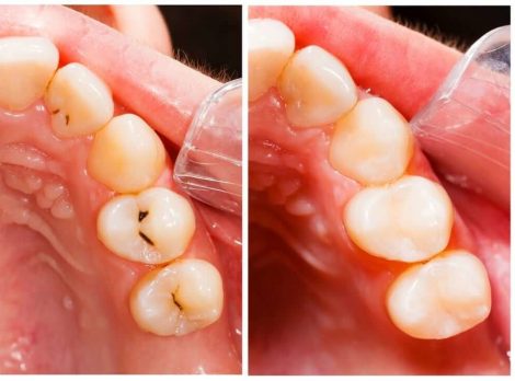 Image of Patient Before and After Composite Tooth-Colored Fillings