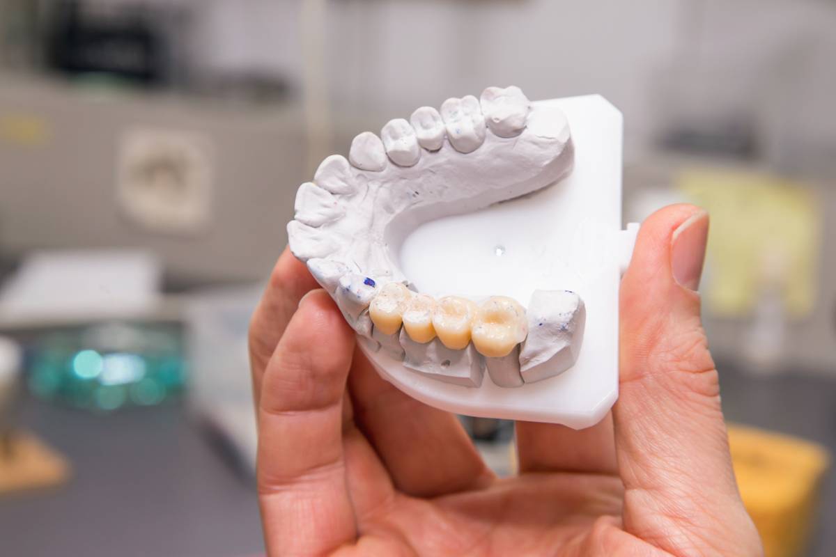 How Many Teeth Can Dental Bridges Replace?