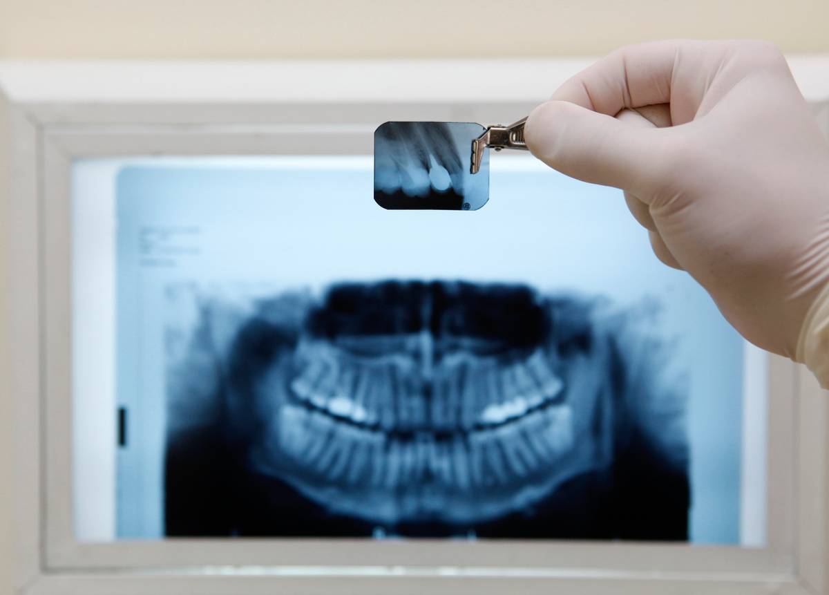 Signs You Need Dental X-Rays