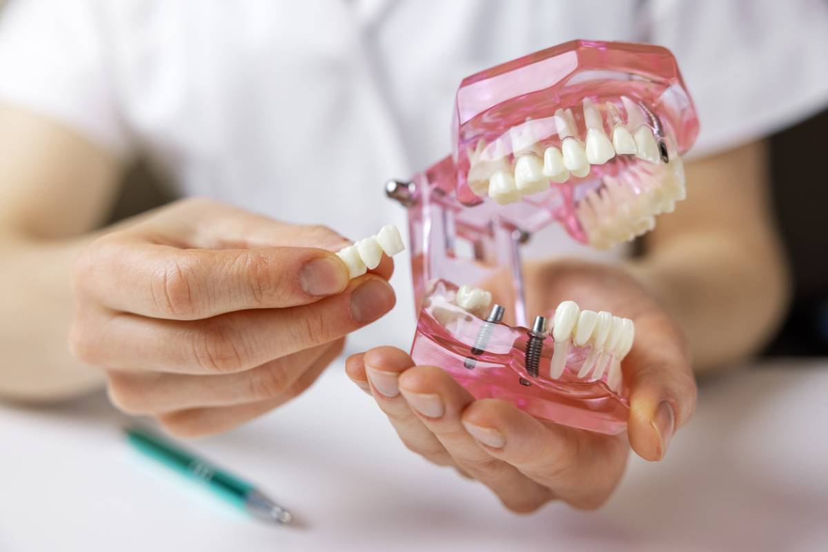 Top 5 Ways to Pay for Dental Implants